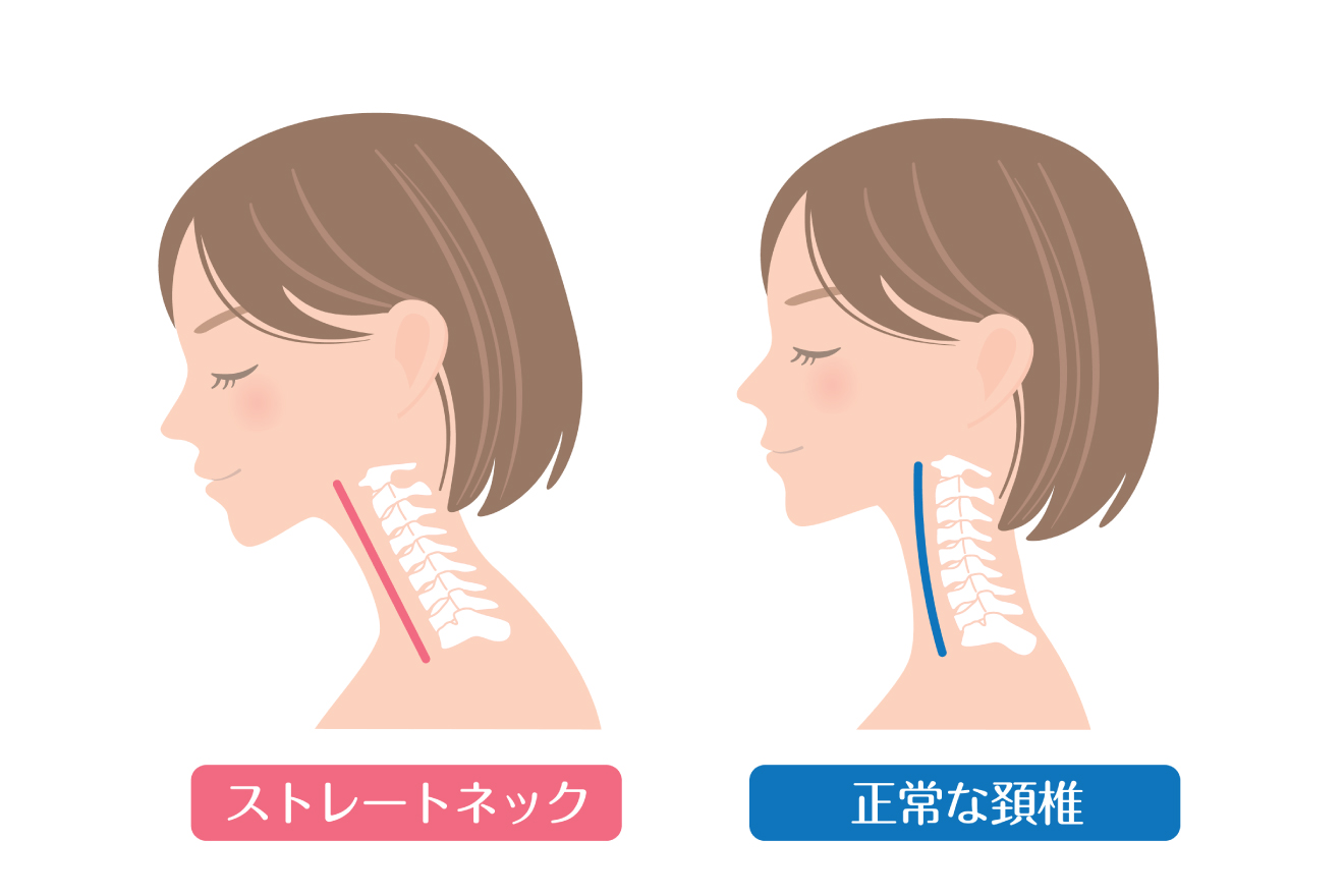 ストレートネックとは何か？